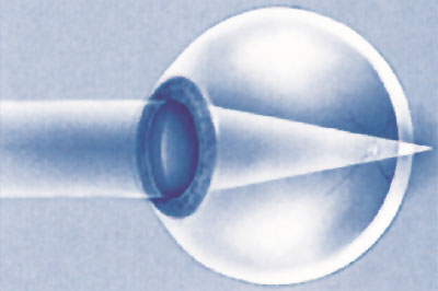 υπερμετρωπία υπερμετρωπία