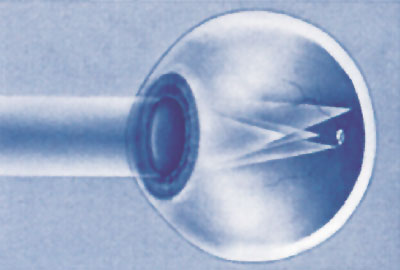 αστιγματισμός αστιγματισμός